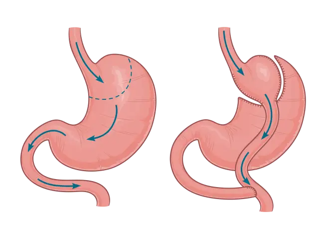 Operacja sleeve to Twoja droga do trwałej redukcji masy ciała?