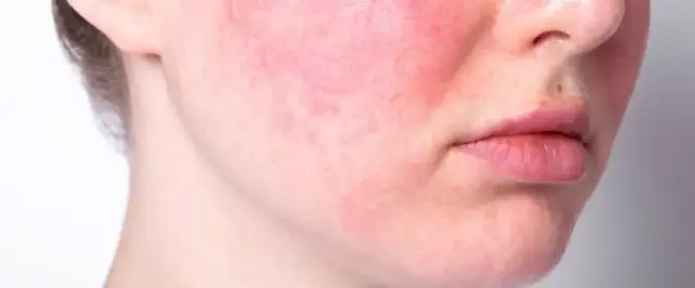 Trądzik różowaty: Skuteczne leki na receptę i bez. Poradnik.