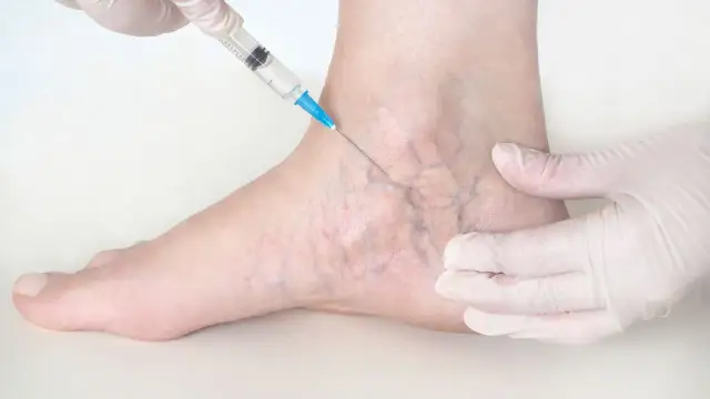 Skleroterapia przed i po - Kiedy znikną pajączki i jak dbać o nogi?