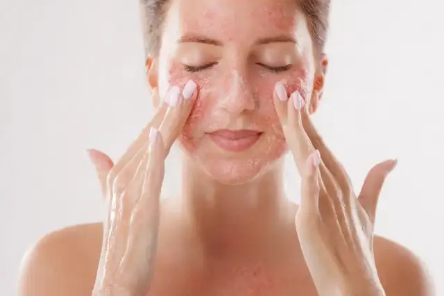 Kobieta z zaczerwienioną skórą twarzy, która może być efektem wysypu po retinolu, delikatnie masuje policzki.