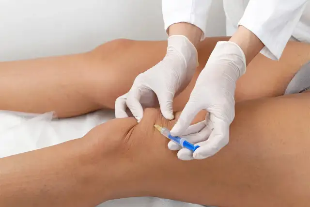 Lekarz wykonuje zastrzyk w kolano z kwasu hialuronowego, aby złagodzić ból i poprawić ruchomość stawu.