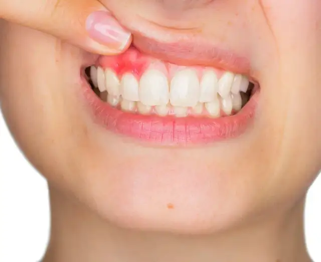 Pękające kąciki, dziąsła, afty: czy to brak witamin? Odczytaj sygnały!