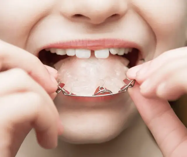 Aparat na zęby dla dziecka: Jak wygląda? Ruchomy, stały, Invisalign