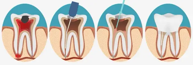 Ból po leczeniu kanałowym: Kiedy jest normalny, a kiedy alarm?