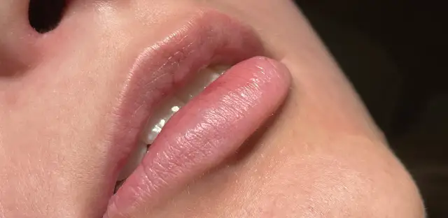 Ile kosztuje powiększanie ust? Ceny, które mogą Cię zaskoczyć