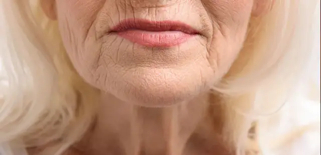 Jak często powtarzać laser frakcyjny, aby uzyskać najlepsze efekty?