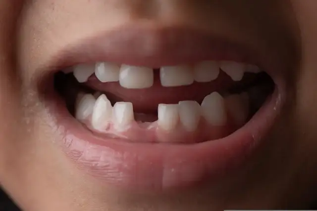 Usta dziecka z widocznym brakiem zęba. Czy zęby to kości? Nie, to twarde struktury chroniące jamę ustną.