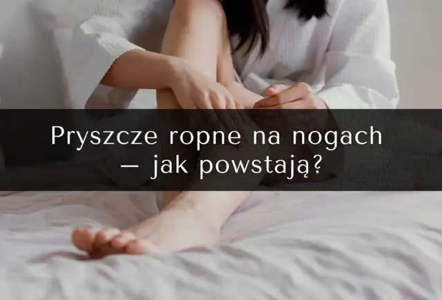 Pryszcze na nogach: przyczyny, skuteczne metody leczenia i profilaktyka