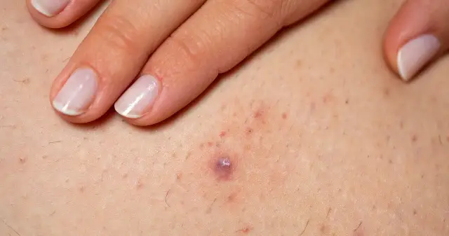 Zapalenie mieszków włosowych: Jak rozpoznać i skutecznie leczyć?