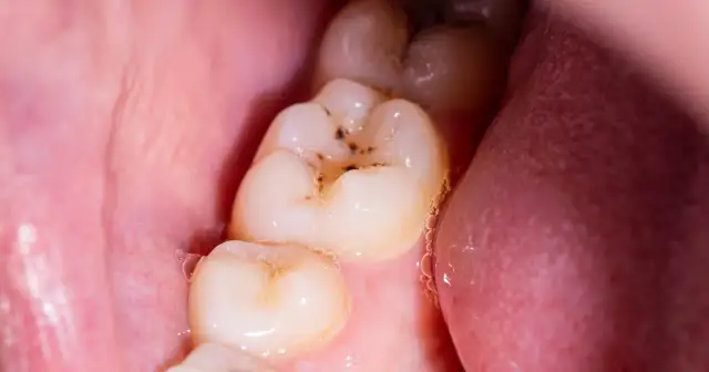 Jak wyleczyć próchnicę w domu? Kiedy to możliwe, a kiedy musisz iść do dentysty?