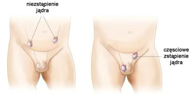 Jedno jądro większe? Kiedy to norma, a kiedy problem?