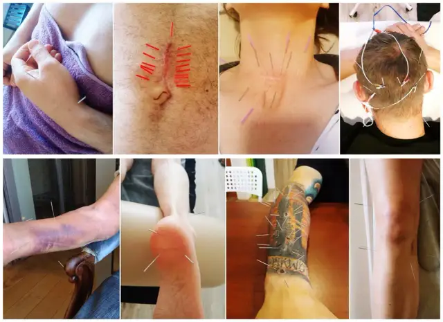 Akupunktura Poznań: Ile kosztuje? Pełny cennik i porady