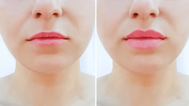 Ile kosztuje powiększanie ust botoksem w Warszawie? Ceny i porady