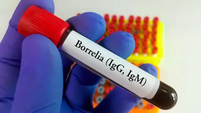 Jak przygotować się do badania na boreliozę, aby uniknąć błędów