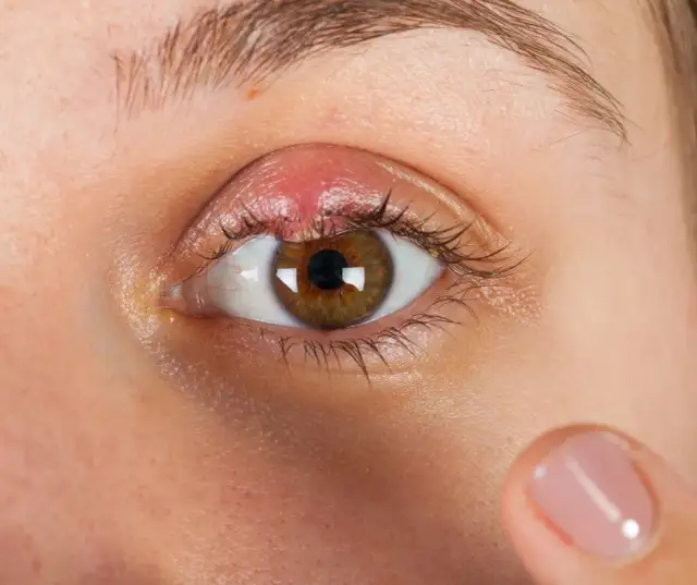 Czy dziecko z jęczmieniem może iść do przedszkola? Sprawdź, jak zadbać o zdrowie.