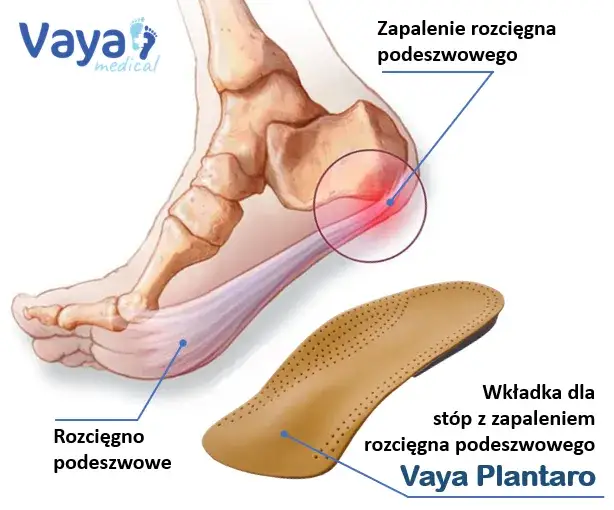 Zapalenie powięzi podeszwy: Leki na ból pięty co naprawdę pomaga?