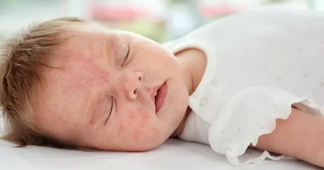 Czy witamina D3 może uczulać? Rzadkie reakcje alergiczne u dzieci