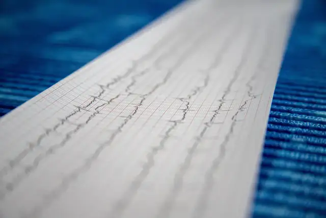 Wynik badania EKG, zapis fal na papierze milimetrowym.