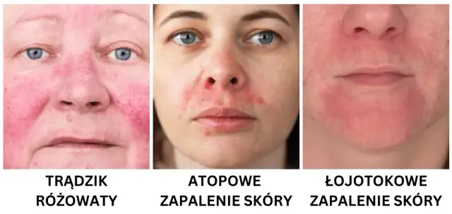 Jak rozpoznać cerę wrażliwą: objawy i skuteczne sposoby na pielęgnację