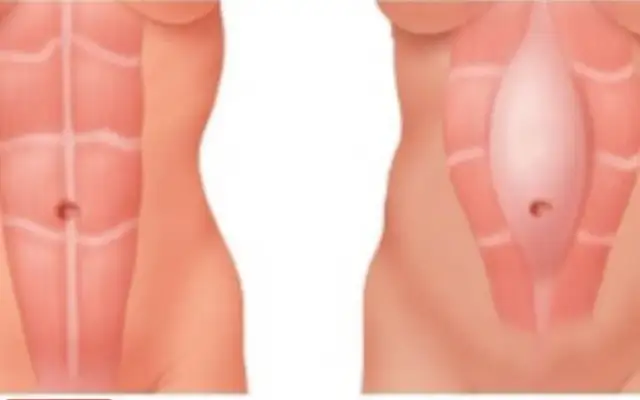 Rozejście mięśni brzucha u dzieci: 5 nieznanych przyczyn