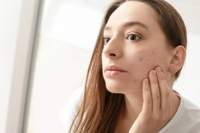 Co mówią pryszcze na twarzy? Rozszyfruj sygnały skóry i zdrowia