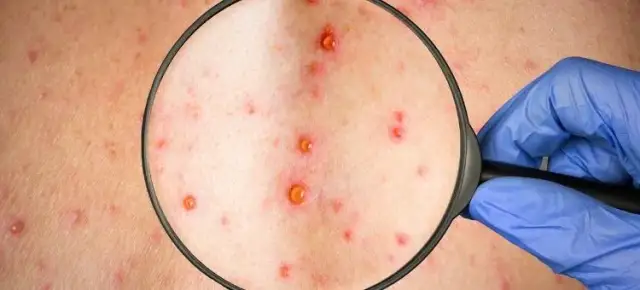 Jak zapobiec ospie po kontakcie z chorym i uniknąć zakażenia