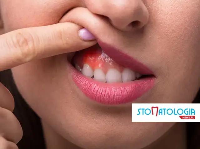 Co zrobić na spuchnięte dziąsło? Szybka ulga i porady eksperta.