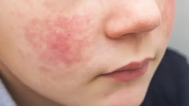 Jak wygląda alergia? Objawy i zmiany skórne, które musisz znać