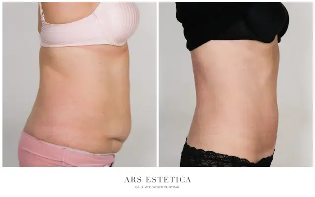 Spektakularne liposukcja brzucha efekty. Porównanie sylwetki przed i po zabiegu.