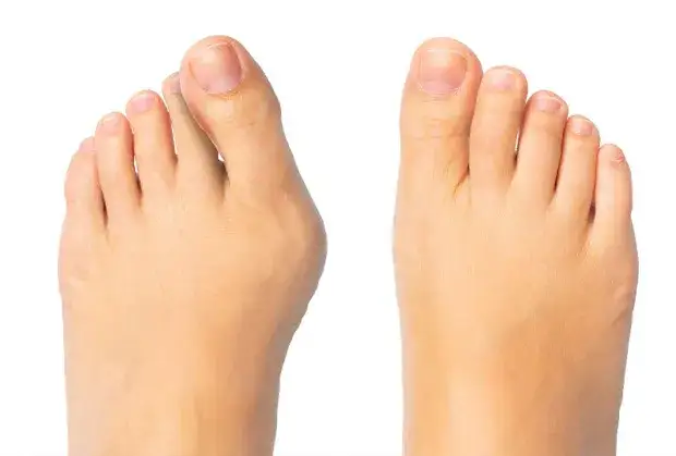 Jak boli haluks? Zrozumienie bólu i objawów palucha koślawego