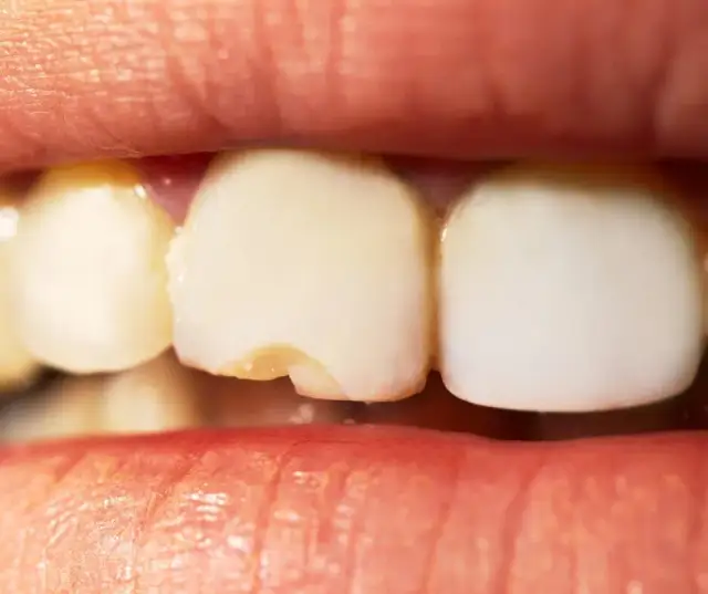 Ukruszony ząb: Koszt naprawy, metody i jak wybrać najlepszą?
