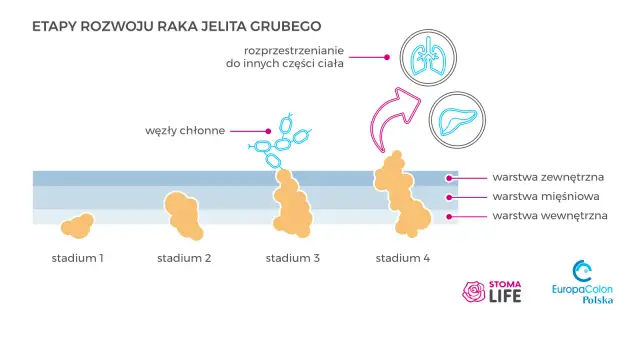 Rak jelita grubego: rokowania. Jak zmienić statystyki na swoją korzyść?
