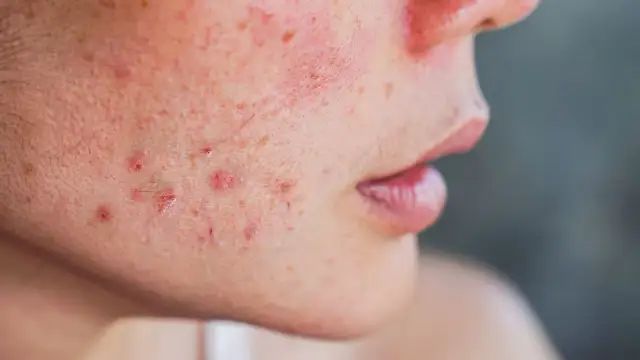 Jakie kosmetyki wybrać na kaszkę na twarzy? Skuteczne sposoby i porady dermatologiczne