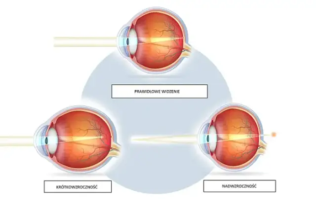 Krótkowzroczność vs. dalekowzroczność: zrozum, koryguj, zobacz lepiej