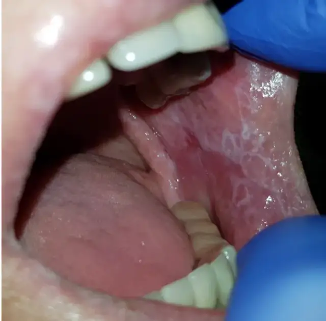 Liszaj płaski w jamie ustnej: Jak skutecznie leczyć i łagodzić ból?