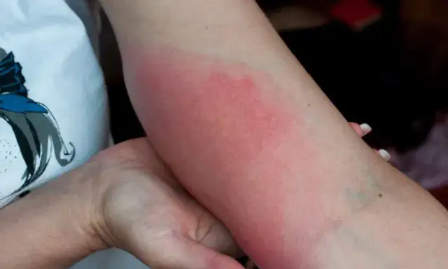 Czy rumień po kleszczu boli? Poznaj objawy i co warto wiedzieć