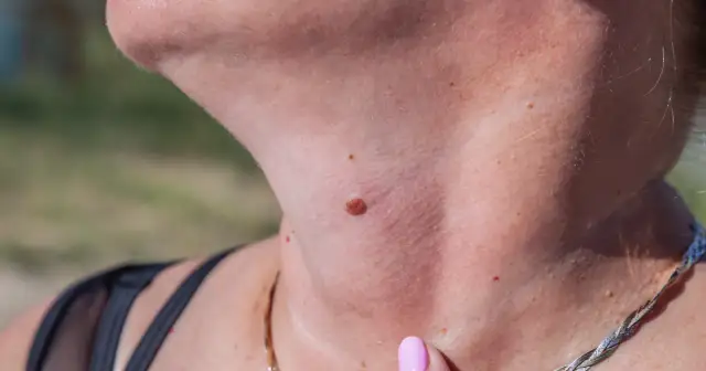 Co oznacza, gdy pieprzyk boli jak pryszcz? Sprawdź to teraz