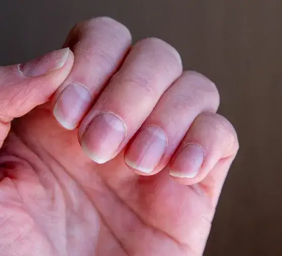 Czy paznokieć odrasta? Dowiedz się, jak długo trwa proces regrowth