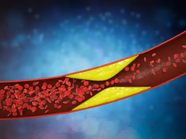 Podwyższony poziom trójglicerydów objawy - co musisz wiedzieć, aby działać