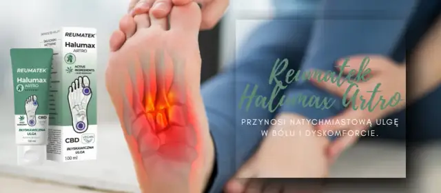 Haluksy: Czym smarować? Maści, zioła i domowe sposoby na ulgę