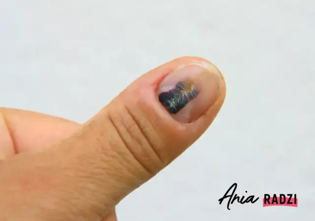 Stłuczony paznokieć: jak leczyć? Kiedy do lekarza, a kiedy domowe sposoby?