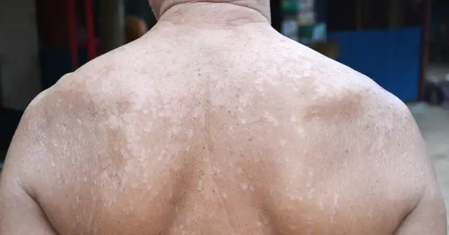 Skąd się bierze łupież? Prawdziwe przyczyny i obalamy mity!