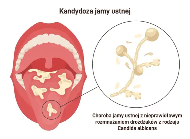Ilustracja jamy ustnej z białymi nalotami, wskazująca na kandydozę. Powiększony fragment pokazuje drożdżaki Candida albicans, które powodują co na grzybicę jamy ustnej.