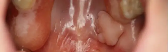 Jak wygląda włókniak w jamie ustnej? Objawy i charakterystyka zmian