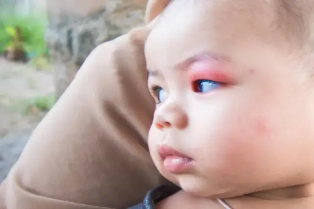 Czy dziecko z jęczmieniem może iść do przedszkola? Sprawdź objawy