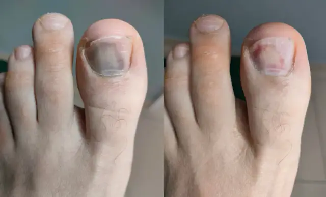 Stłuczony paznokieć: Jak szybko uśmierzyć ból i wyleczyć uraz?