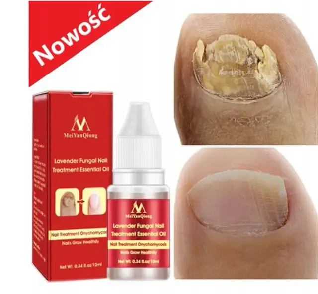 Najlepsze leki na grzybicę paznokci: skuteczne metody leczenia