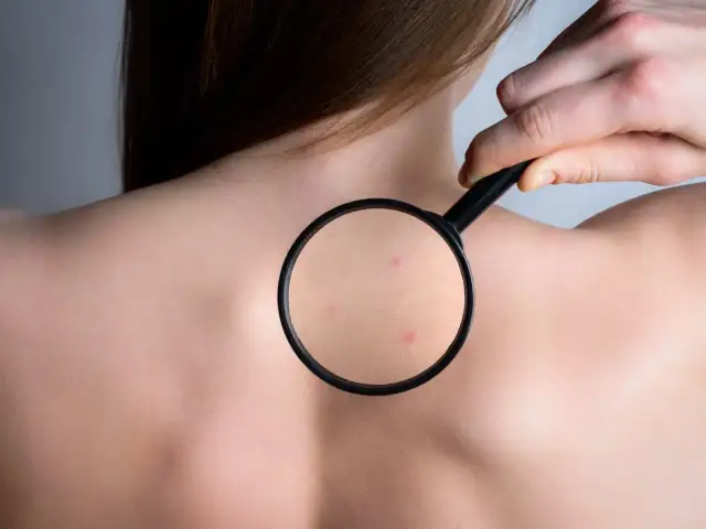 Dłoń z lupą bada skórę na plecach, ukazując drobne pryszcze.