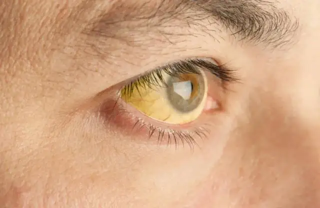 Zespół Gilberta a objawy psychiczne – co warto wiedzieć?