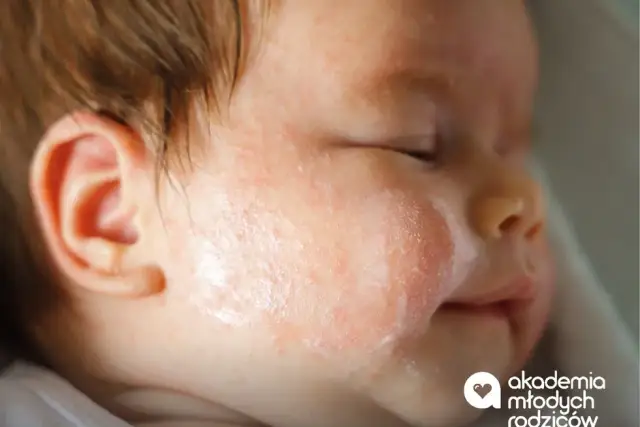 Alergia pokarmowa: objawy na skórze? Rozpoznaj i reaguj!